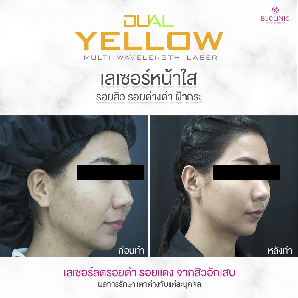 Dual Yellow หลังทำ