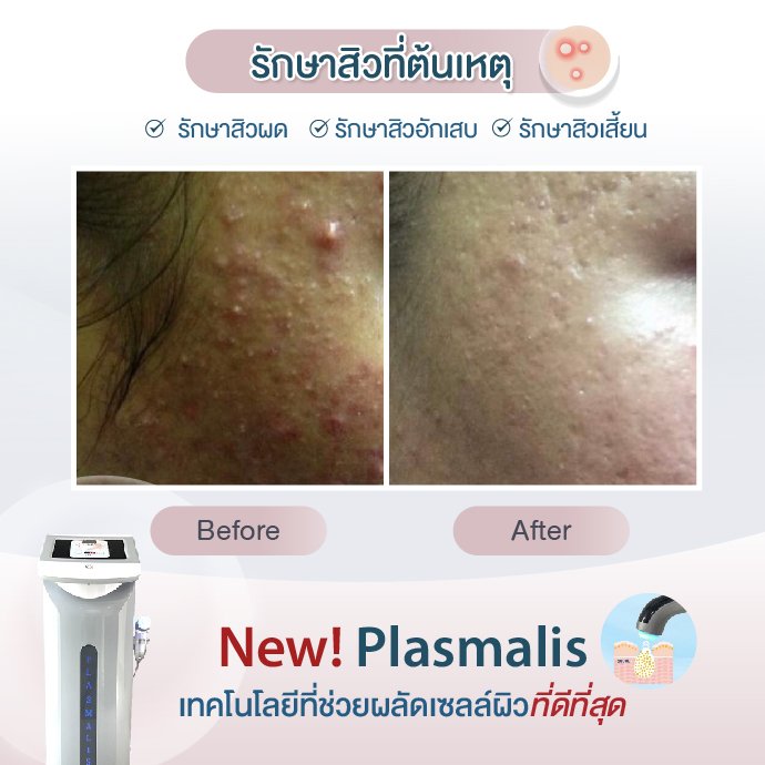 Plasma Claer รีวว