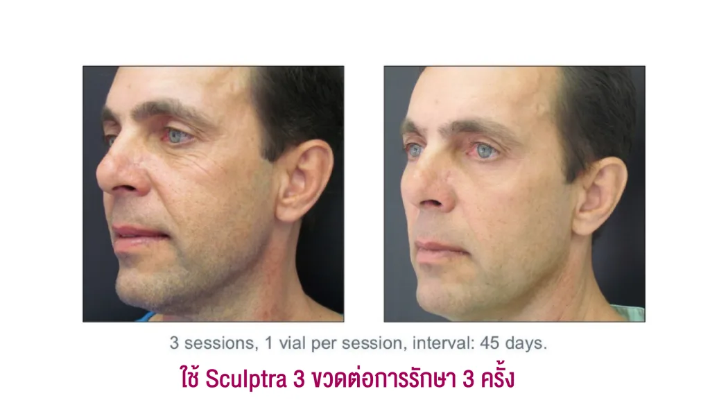 Sculptra Review