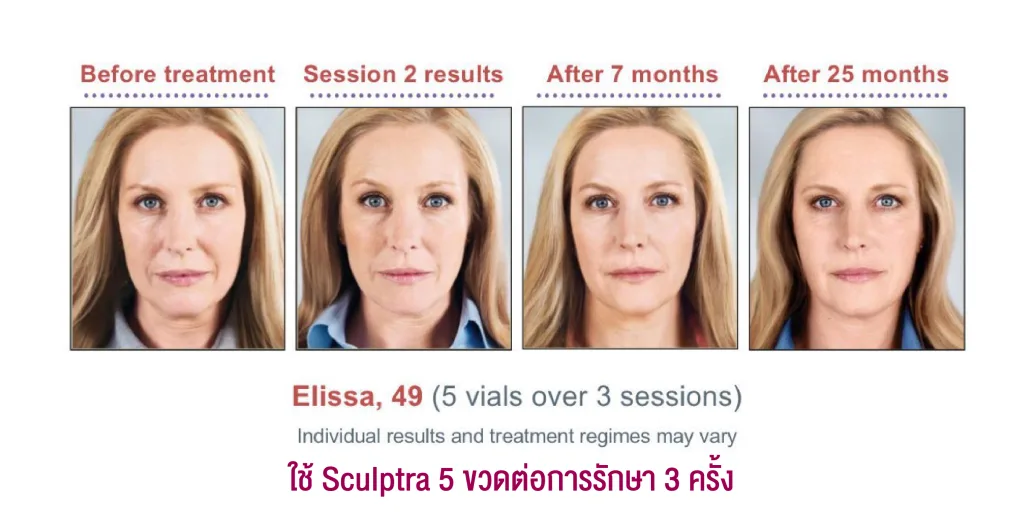 รีวิว Sculptra