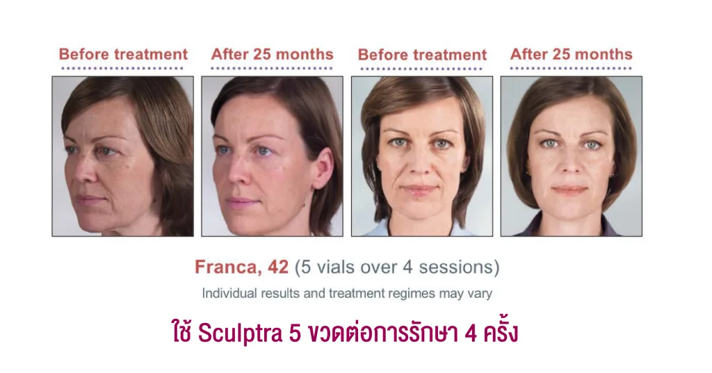 รีวิว Sculptra