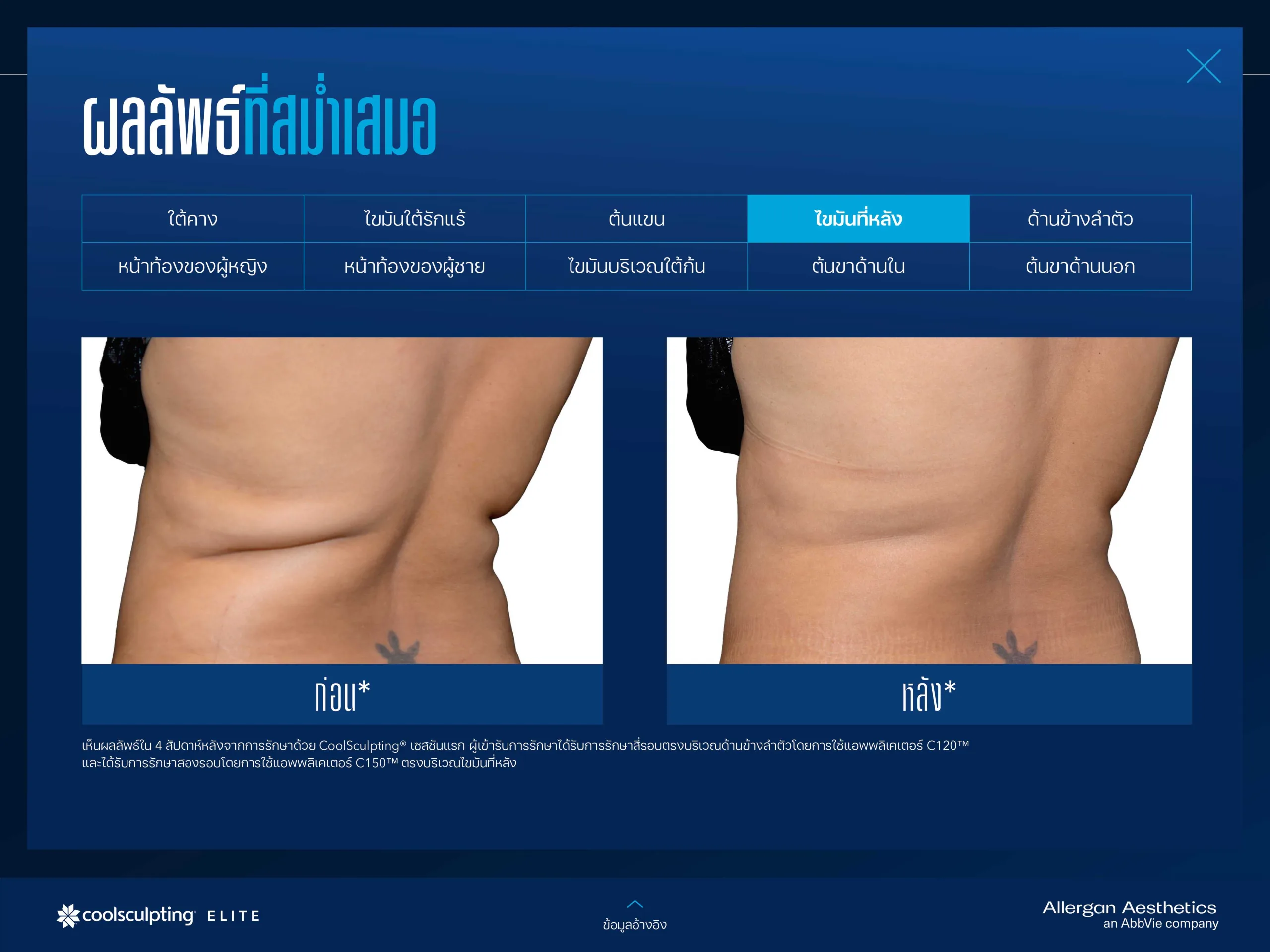 CoolSculpting โคราช