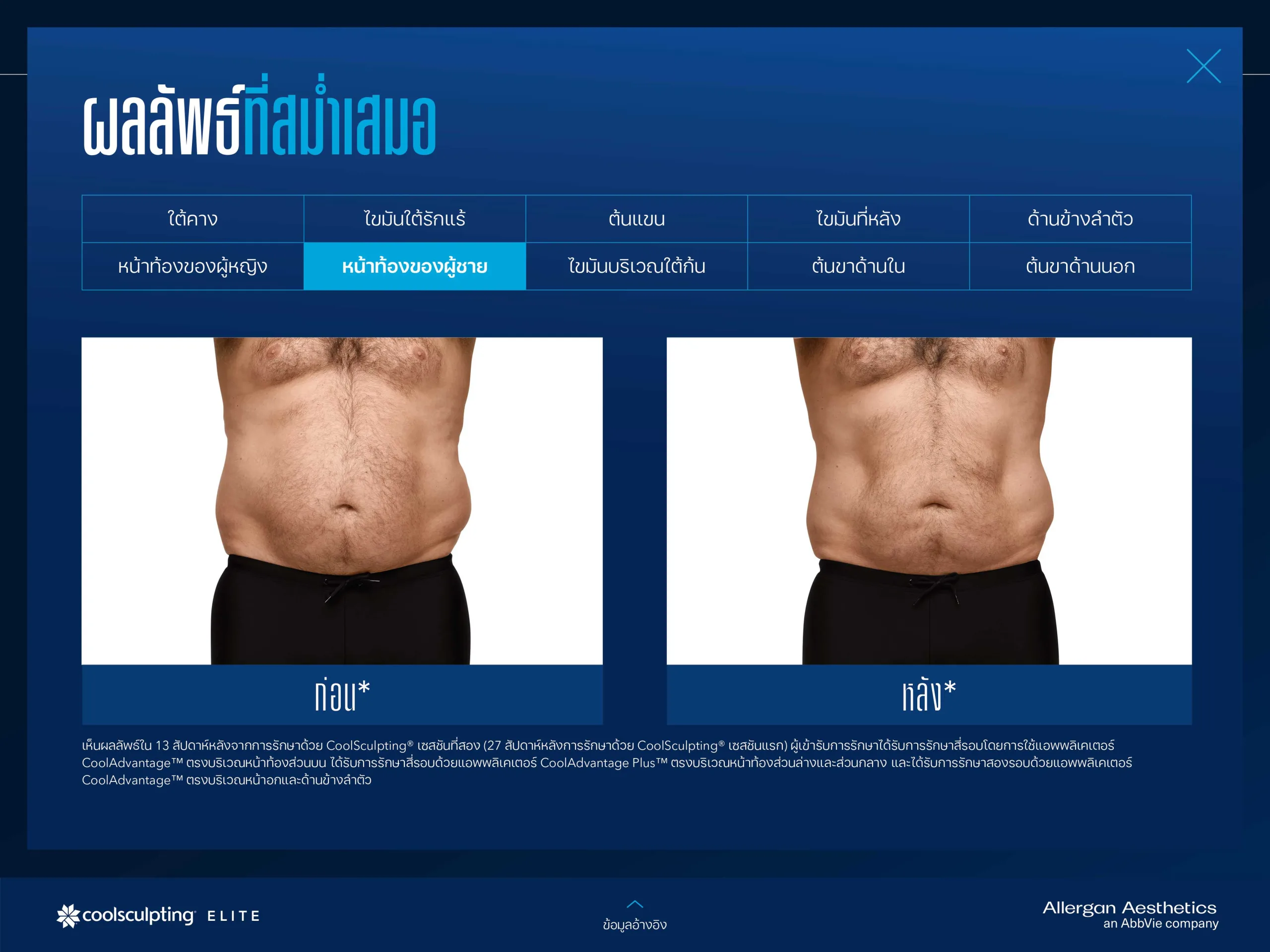 CoolSculpting รีวิว