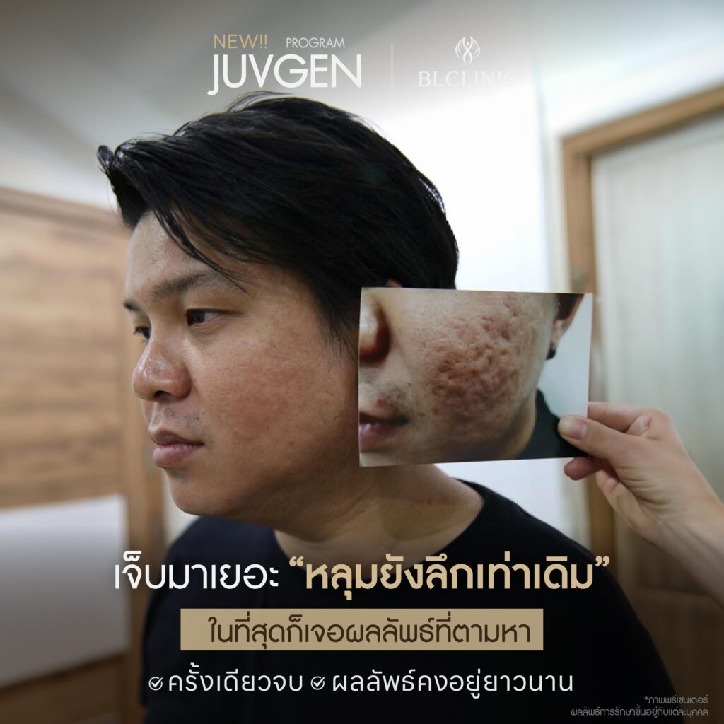รีวิว PROGRAM JUVGEN