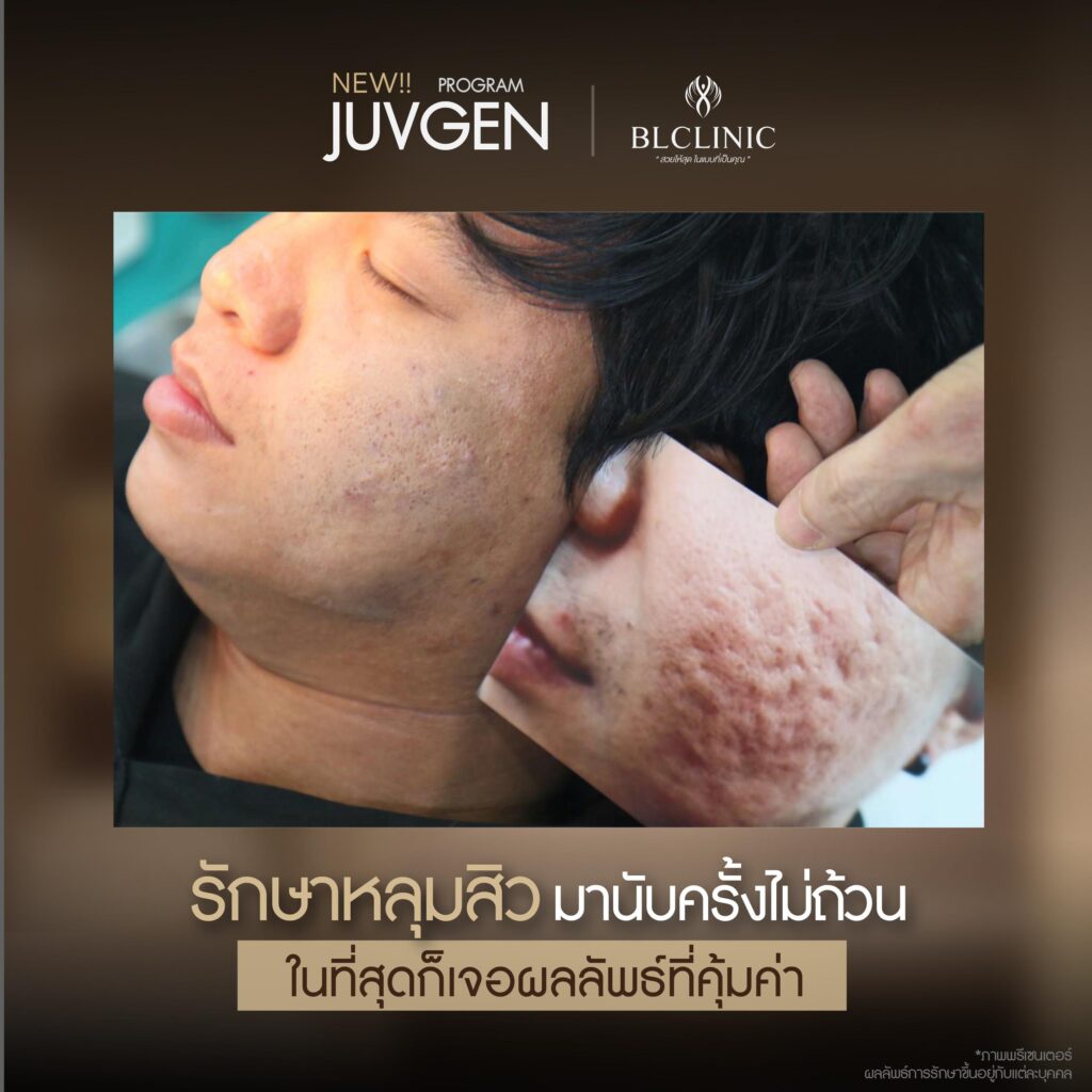 รีวิวรักษาหลุมสิวด้วย PROGRAM JUVGEN