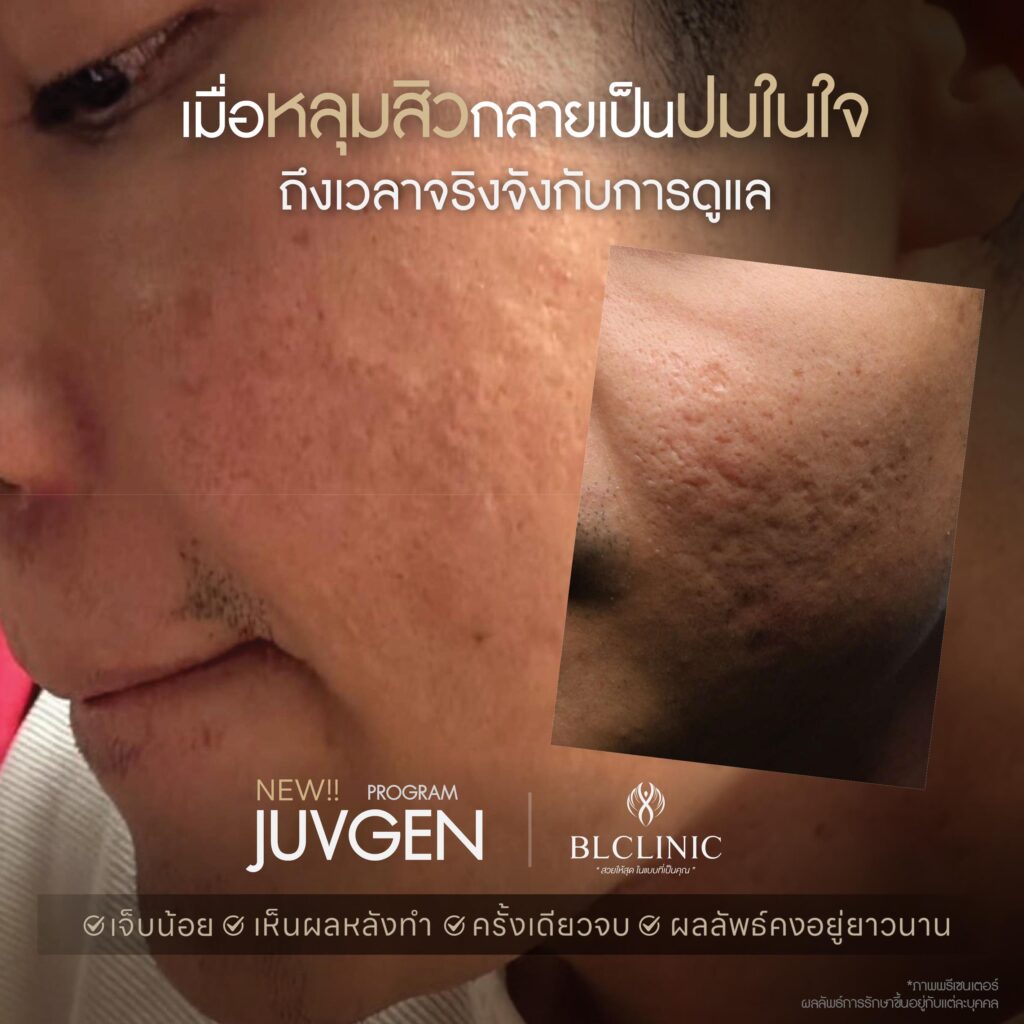 รักษาหลุมสิวรีวิว