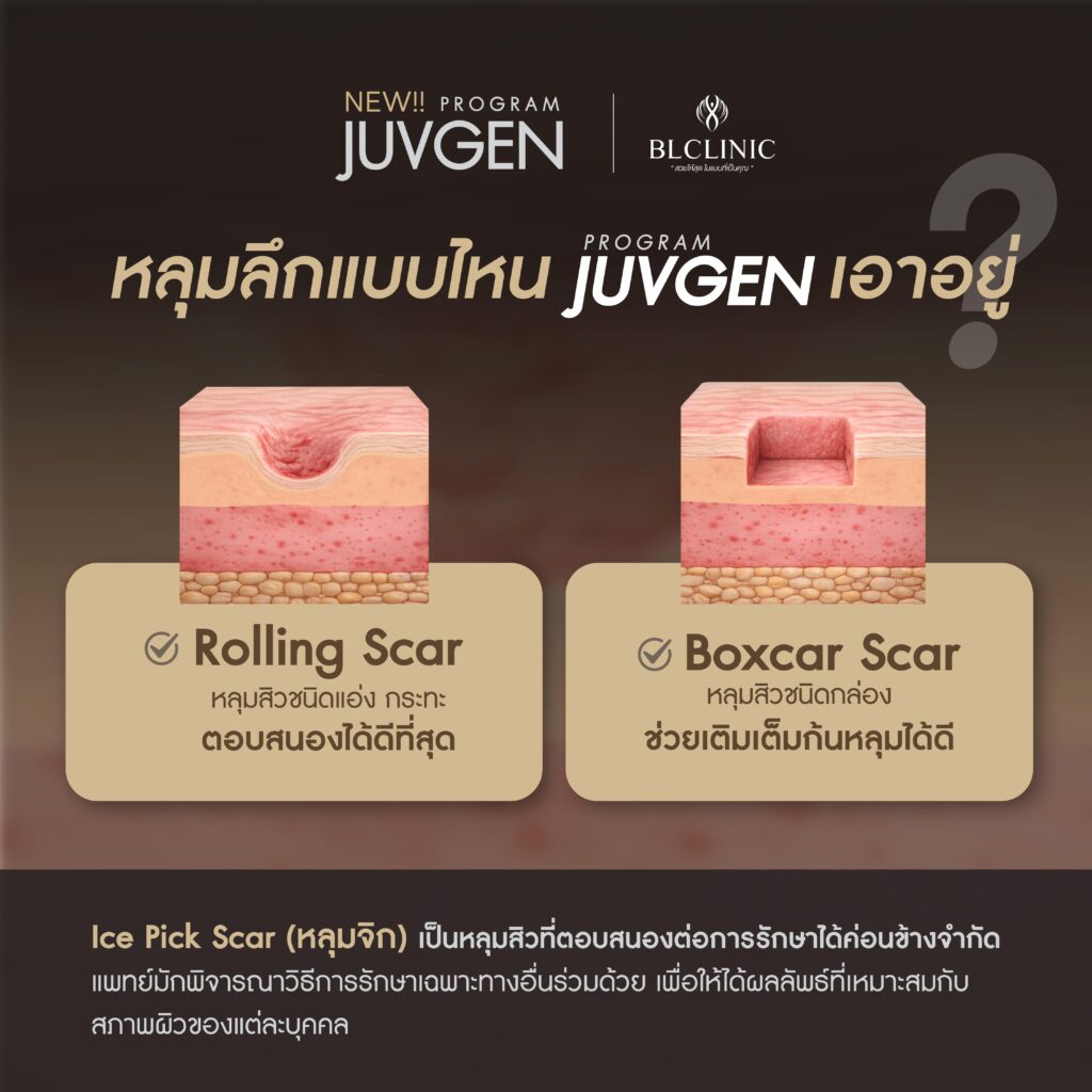 ประเภทของหลุมสิว