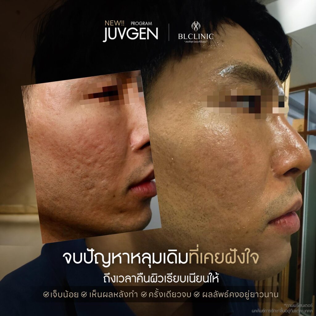 รีวิวผิวหลังรักษาหลุมสิวด้วย PROGRAM JUVGEN