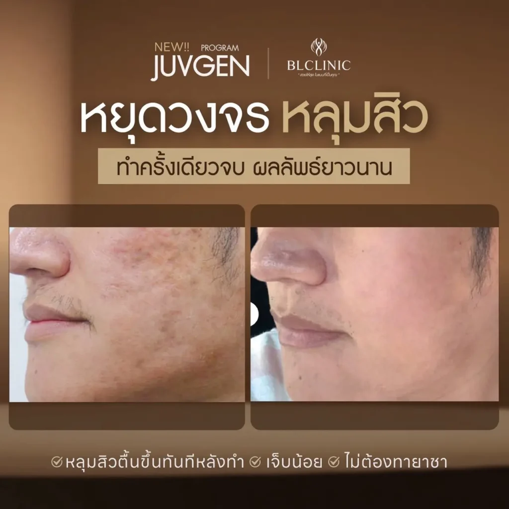 รีวิว PROGRAM JUVGEN โคราช