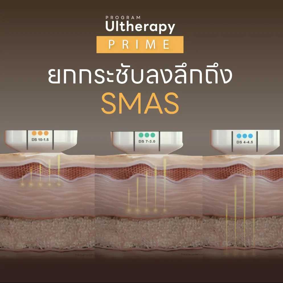 ทำ PROGRAM Ultherapy PRIME ถึงชั้น SMAS