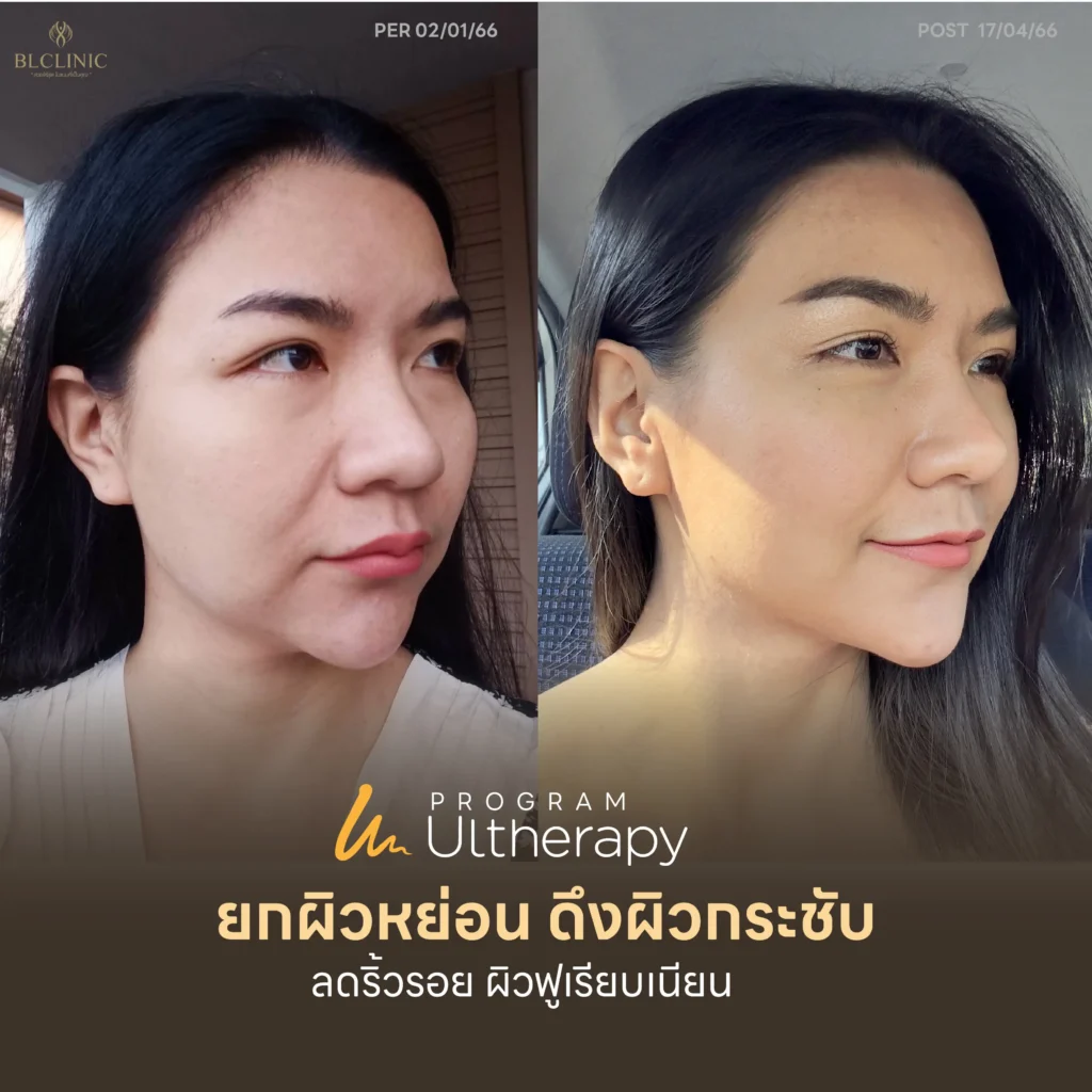 ทำ PROGRAM Ultherapy PRIME ที่ไหนดี 2569