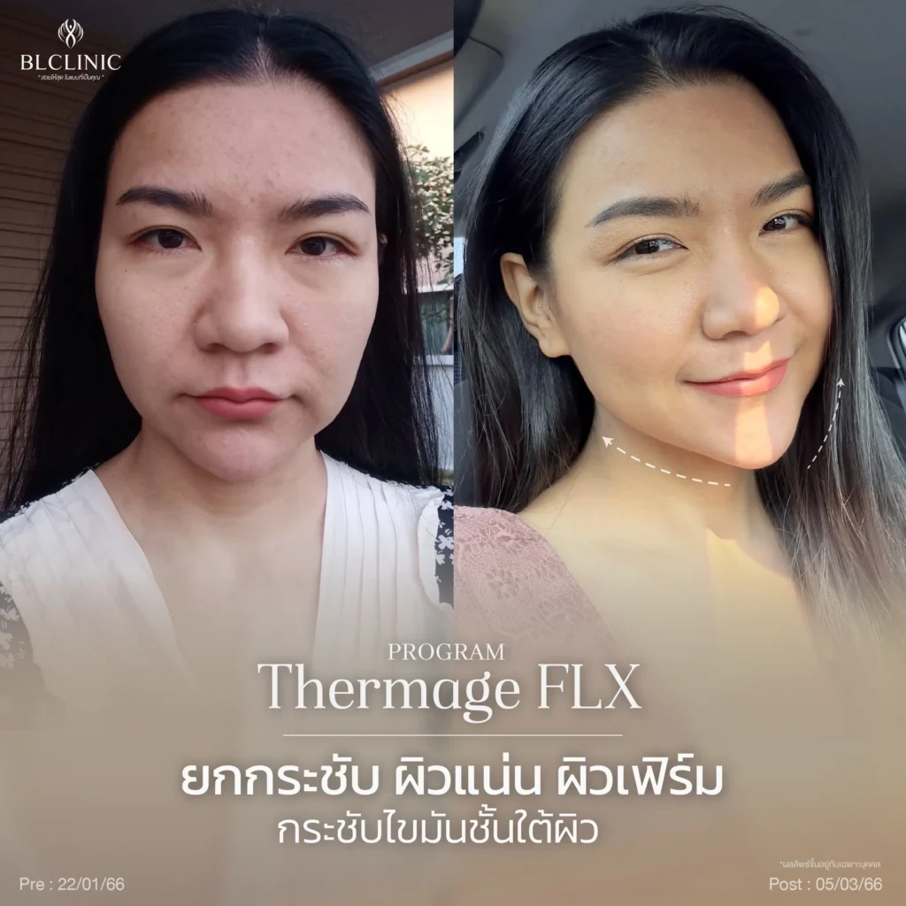 รีวิว PROGRAM Thermage FLX
