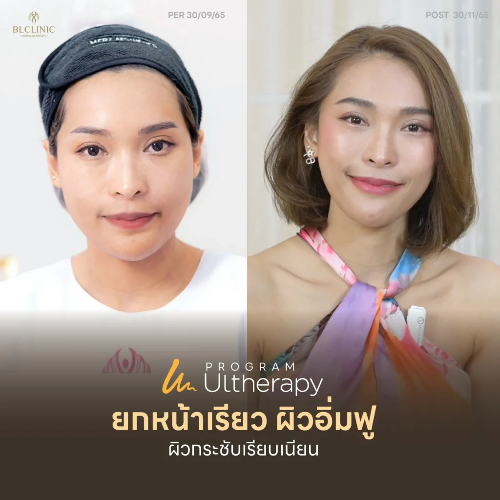 รีวิว PROGRAM Ultherapy PRIME โคราช