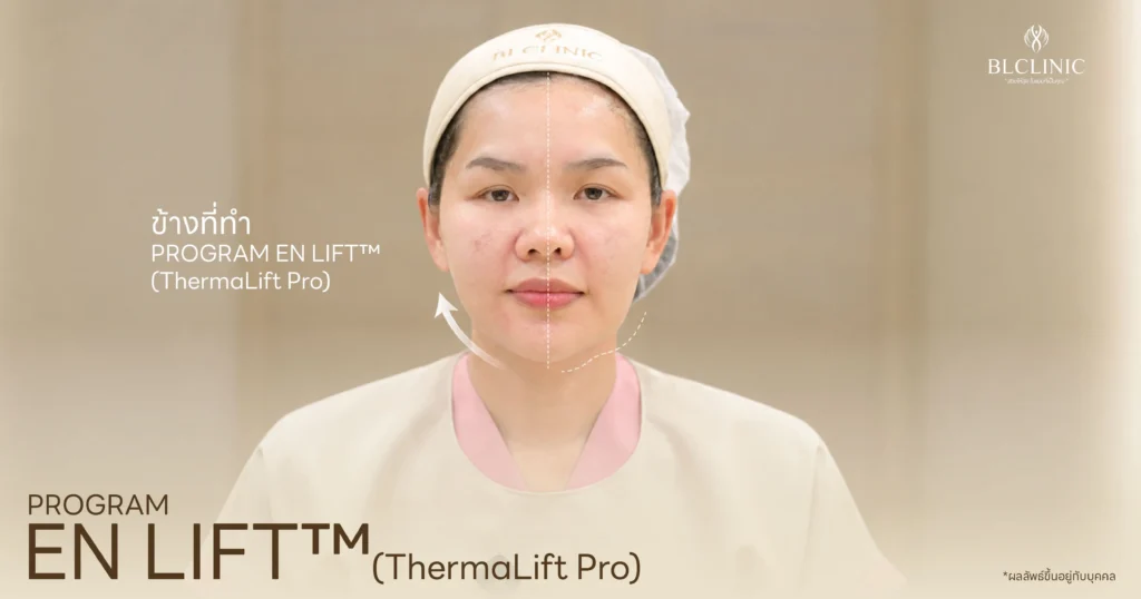 เปรียบเทียบ PROGRAM EN LIFT™