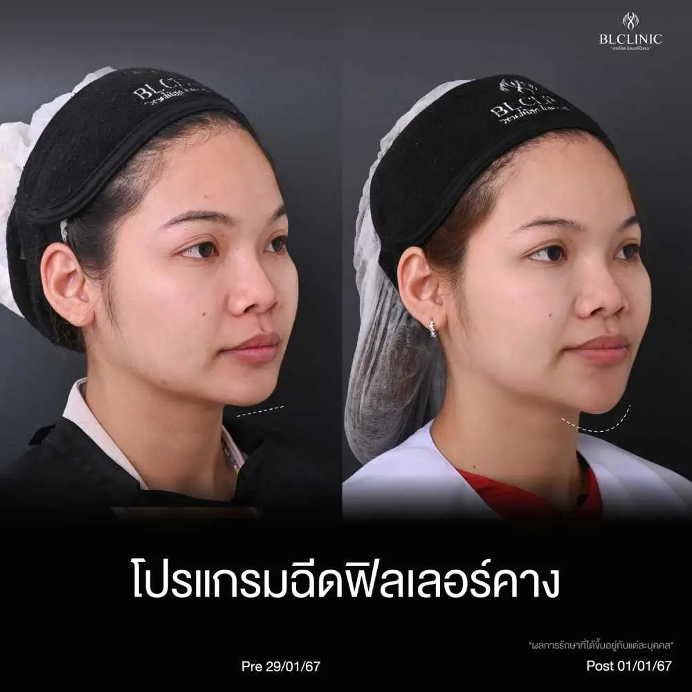 ความแตกต่างก่อน และหลังทำ PROGRAM ฟิลเลอร์