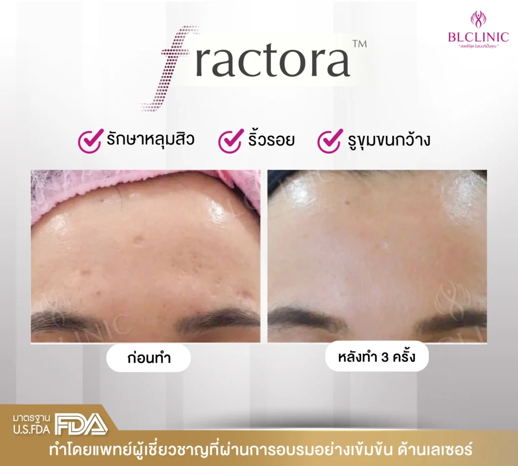 รักษาหลุ่มสิว PROGRAM Fractora