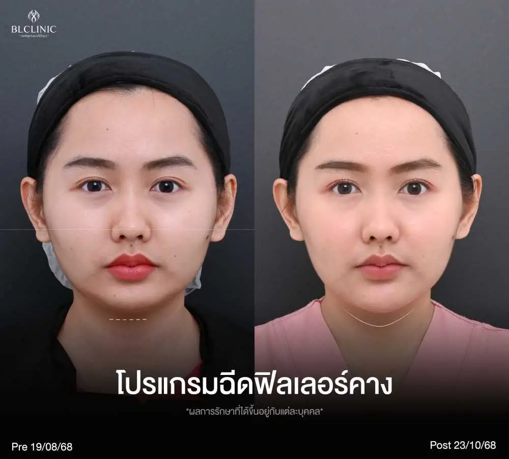 เปรียบเทียบ PROGRAM ฉีดฟิลเลอร์ โคราช